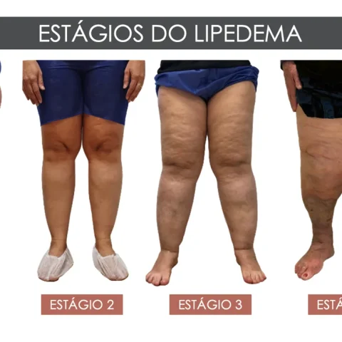 estagios-do-lipedema